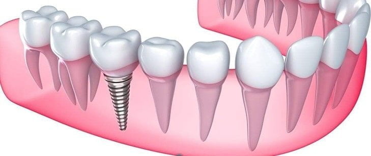 32 diş implant fiyatları
