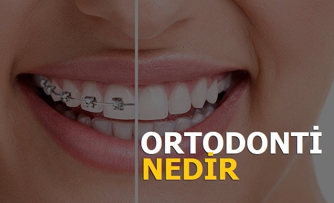 Ortodonti nedir