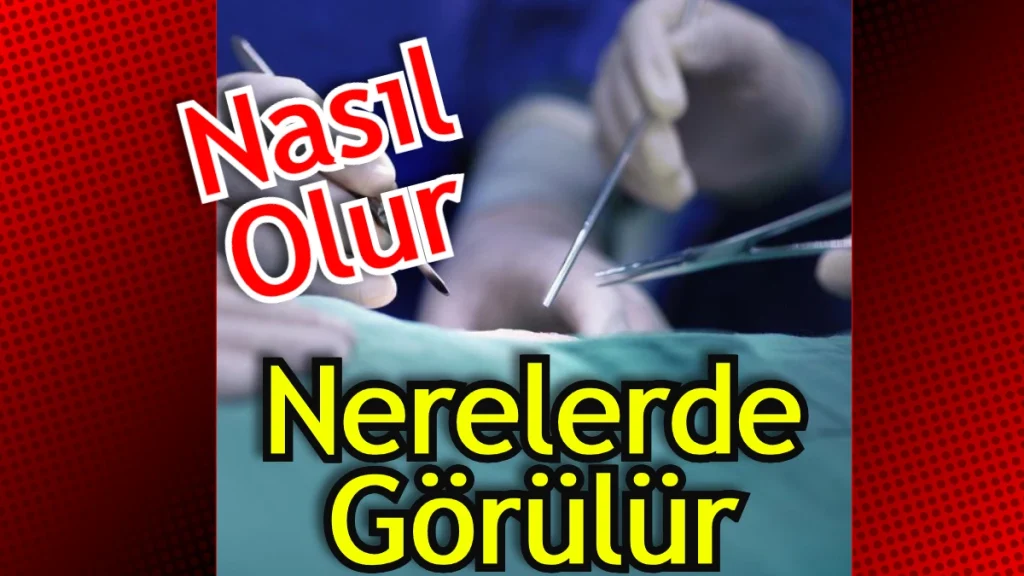 Laserasyon Nedir Tıp