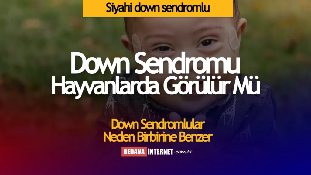 Siyahi down sendromlu