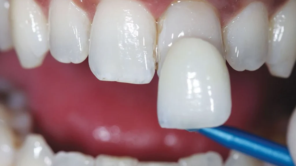 Uygun fiyatlı en i̇yi diş kaplaması hangisi - sağlam diş kaplama çeşitleri