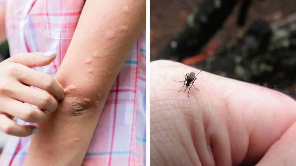 Sivrisineklerden kurtulmanın yolları